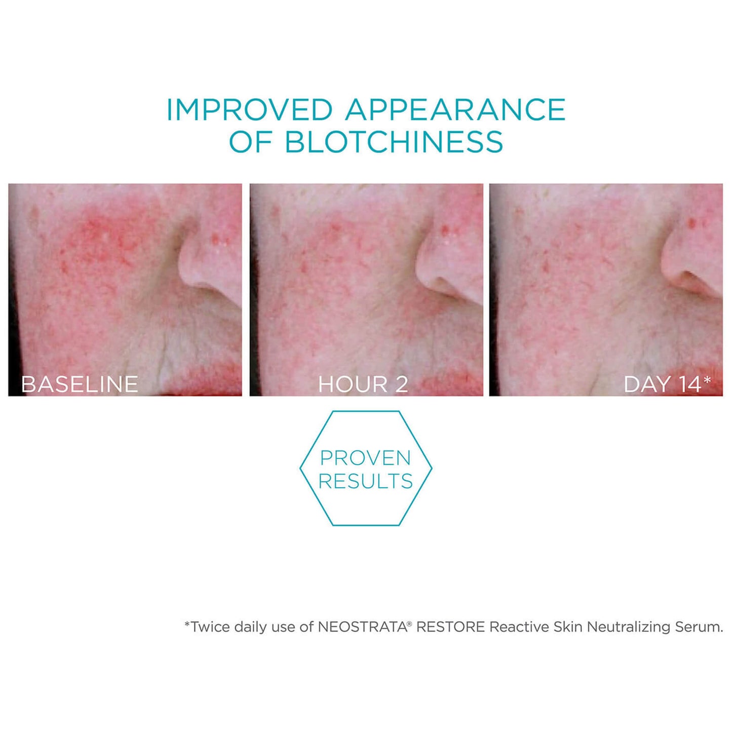 Neostrata Restore Redness Neutralising Serum for Sensitive Skin 29g